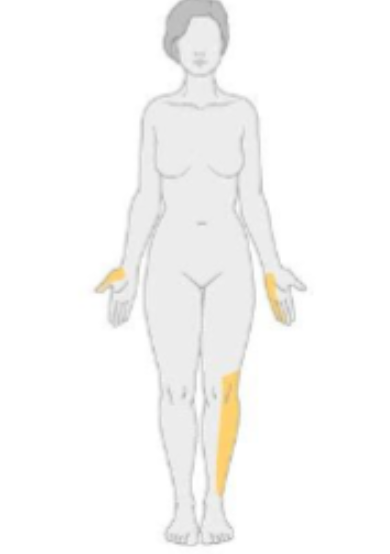<p>what type of neuropathy would have the following distribution?&nbsp;</p>