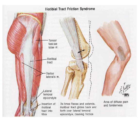 <ul><li><p>Ilio-tibial band: thick band of CT (fascia)</p><ul><li><p>Gerdy's tubercle: attachment point on lateral tibia</p></li></ul></li><li><p>MOI: Overuse (compression &amp; shear forces)</p><ul><li><p>Lateral epicondyle of femur</p></li><li><p>Friction @ 20-30 degrees</p></li></ul></li><li><p>S/S: lateral knee pain w running, point tender, swelling</p></li><li><p>Risk factors: Excessive Q-angle, tightness, excessive running</p></li><li><p>Pathophysiology: friction irritates ITB, lateral synovial recess (bursae), bursitis: inflammation</p></li></ul><p></p>