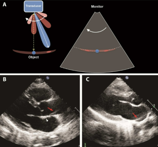 <ul><li><p><span style="background-color: transparent;">Echoes from <strong><u>weaker</u></strong> beams outside the main beam from an <strong><u>array</u></strong> transducer</span></p></li><li><p><span style="background-color: transparent;">Appears as duplicated structures laterally</span></p><ul><li><p><span style="background-color: transparent;">Seen a lot with echo</span></p></li></ul></li><li><p><span style="background-color: transparent;">Reduced with harmonics</span></p></li></ul><p></p>