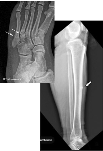<p>What type of fracture is this?</p>