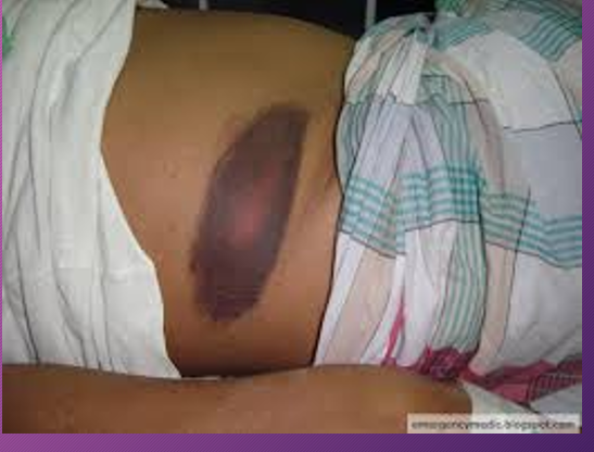 <p>Gray Turner’s sign is an uncommon _________ manifestation of intra-abdominal pathology that manifests as _______ of the _____. </p>