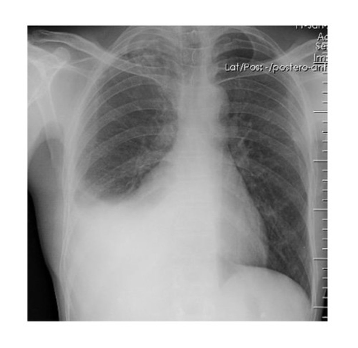 <p>a 60 year old presents to the ER with chest pain, shortness of breath, and mild cough. pt gets a thorough work up, and his CXR shows this</p>