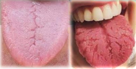 <p><strong><u>Fissured tongue (scrotal tongue)</u></strong></p><p class="has-focus">Polygenic or autosomal dominant trait</p><p class="has-focus">Down syndrome</p><p class="has-focus">Dry mouth</p><p class="has-focus">Diabetes</p><p class="has-focus">Becomes more prominent with age</p><p class="has-focus"></p><p class="has-focus is-empty"><strong>Treatment </strong>- Brush/scrape tongue (proper oral hygiene). Cant cure but hygeine may reduce prominence.</p><p class="has-focus"></p><p class="has-focus is-empty"><em>DD - Erythema migrans, Macroglossia with crenations, Hemihyperplasia of tongue, Orofacial granulamatosis</em></p>