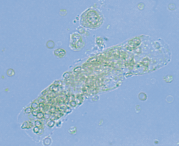 <p>Most fragile cast that indicates bleeding w/n the nephron</p>