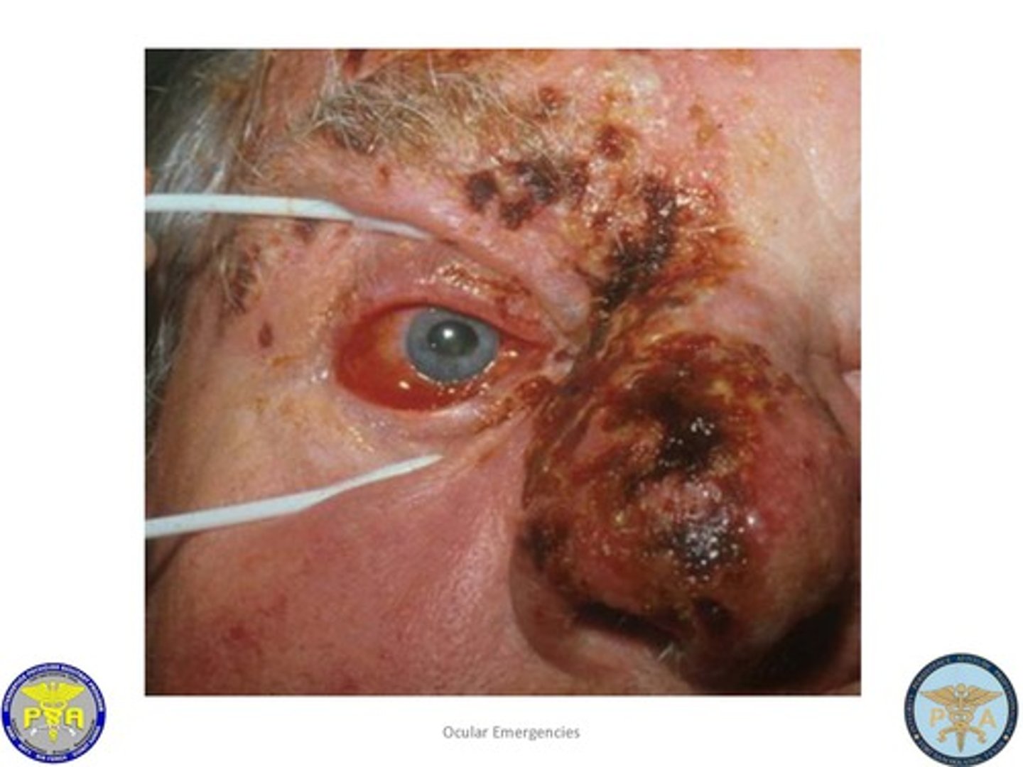 <p>Zoster ophthalmicus</p>