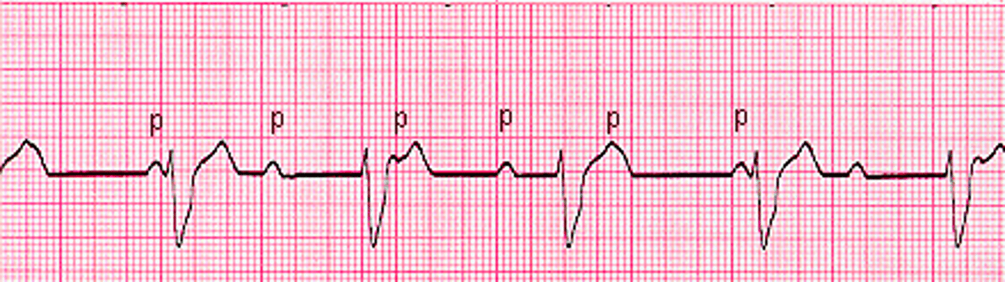 <p>Atrials and ventricles don't communicate</p><p>Rate: regular atrial</p><p>P wave: Present, upright</p><p>No relationship between P waves and QRS</p><p>PR Interval: VARIABLE</p><p>QRS: variable</p><p>P-P ad R-R consistent but NO correlation</p><p>Husband and wife live separate lives and don't communicate</p>