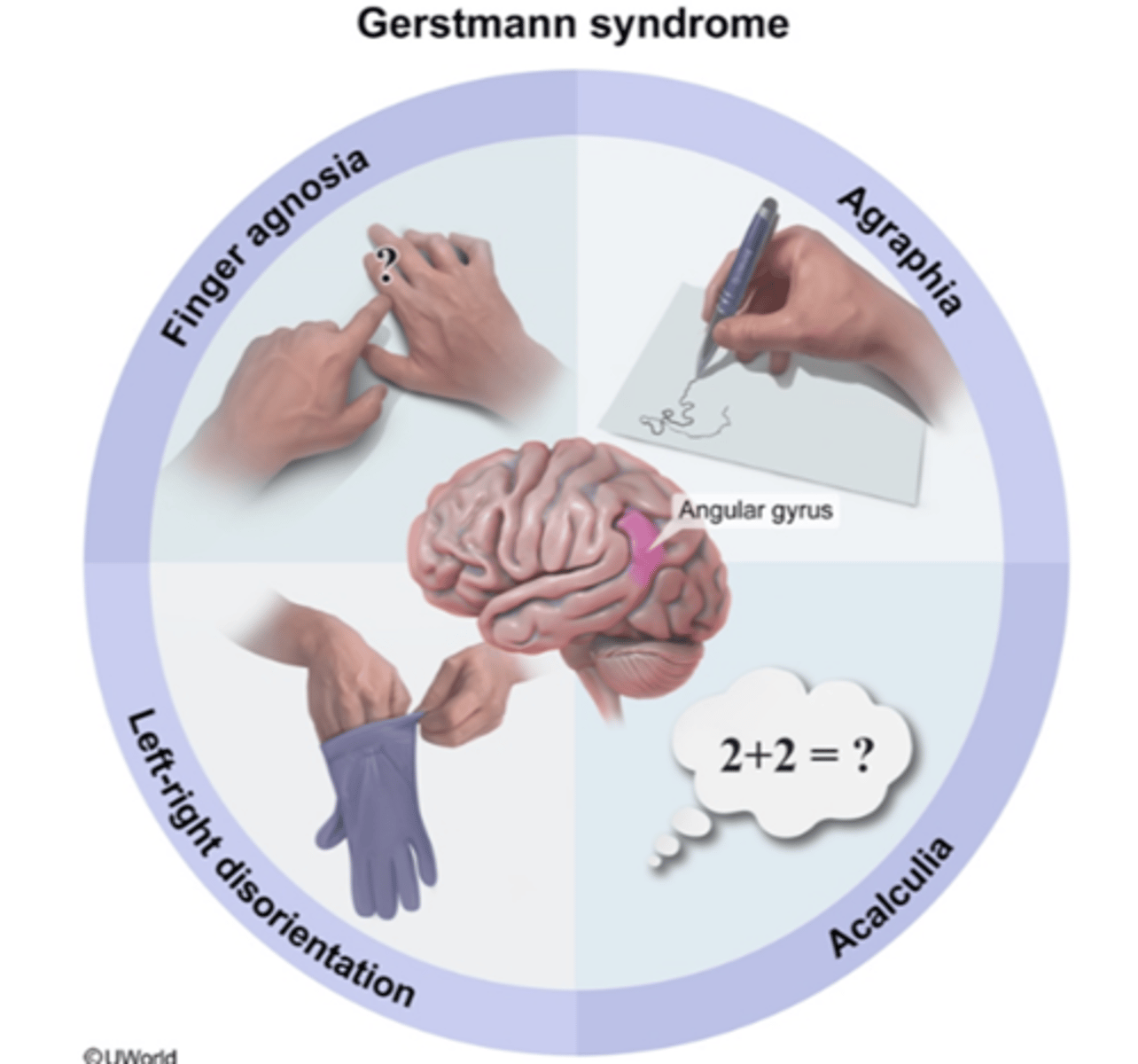<p>cluster of symptoms:<br>- finger agnosia: patients will identify other objects as their fingers/toes &amp; vice versa<br>- hard to differentiate between left &amp; right<br>- dsycalculia: problems with calculations<br>- dsygraphia: problems with writing (can read but cannot write)<br>- anosognosia</p>