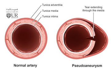 <p>Pseudoaneurysm</p>
