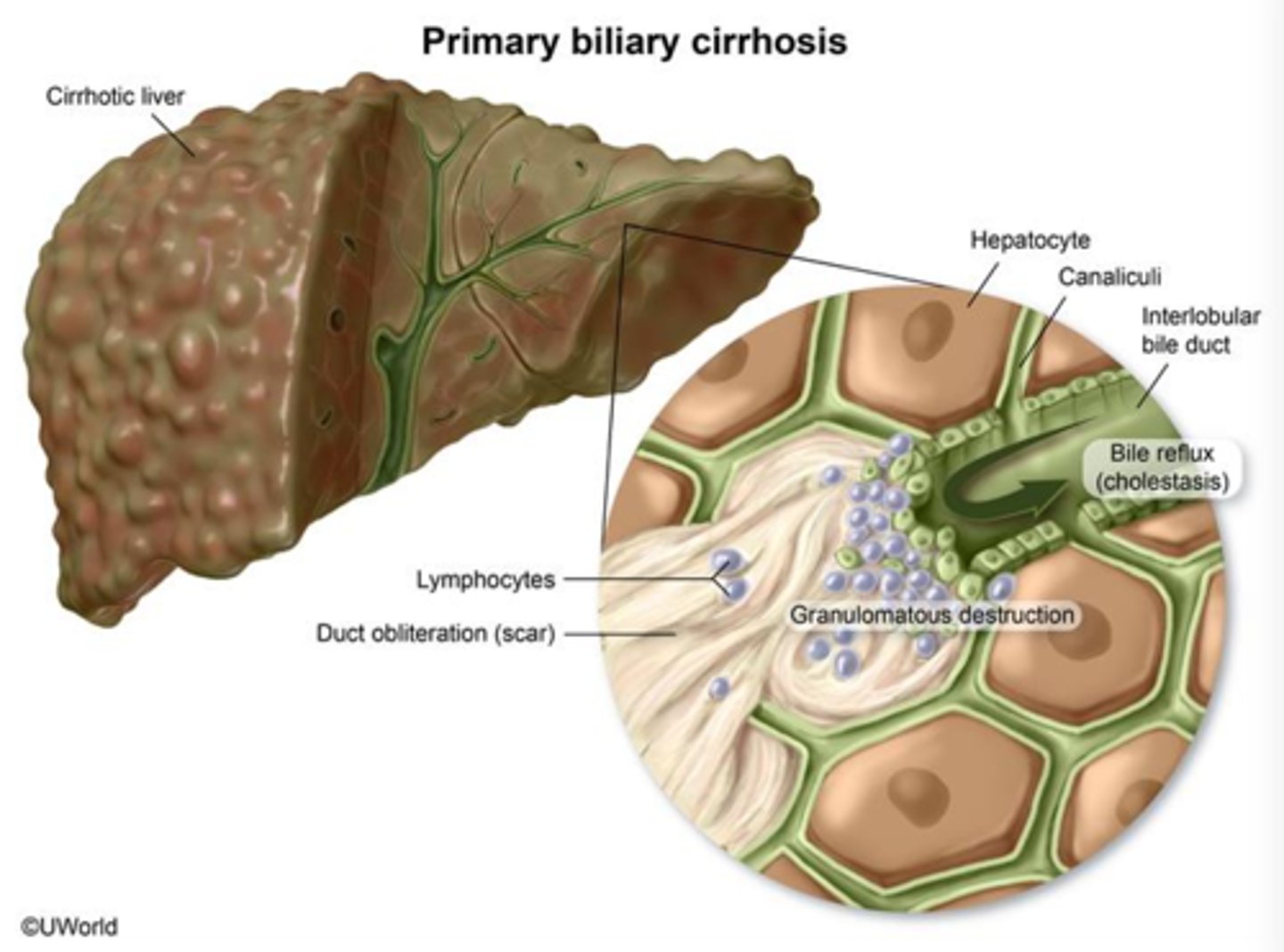 <p>-autoimmune: auto antibodies target bile ductal epithelial cells (not hepatocytes)</p><p>-inflammatory destruction of intrahepatic bile ducts</p>
