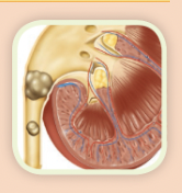 uretero / lith / iasis = ureter / stone / presence 
Definitio: presence of stones in a ureter 