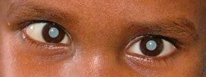 <p><strong>A 4-year-old boy who has been deaf since birth and has bilateral cataracts has been brought to the emergency department by his mother because she noticed blood in the toilet after he last voided. Urinalysis confirms heavy microscopic hematuria as well as proteinuria. What will the health care team's initial differential diagnosis most likely be?</strong></p><p>A) Alport syndrome</p><p>B) Systemic lupus erythematosus glomerulonephritis</p><p>C) Henoch-Schönlein purpura nephritis</p><p>D) Immunoglobulin A nephropathy </p>