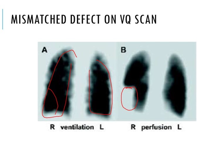 Only used if:

* normal CXR
* no concurrent symptomatic CVD
* inconsistent with clinical suspicion 