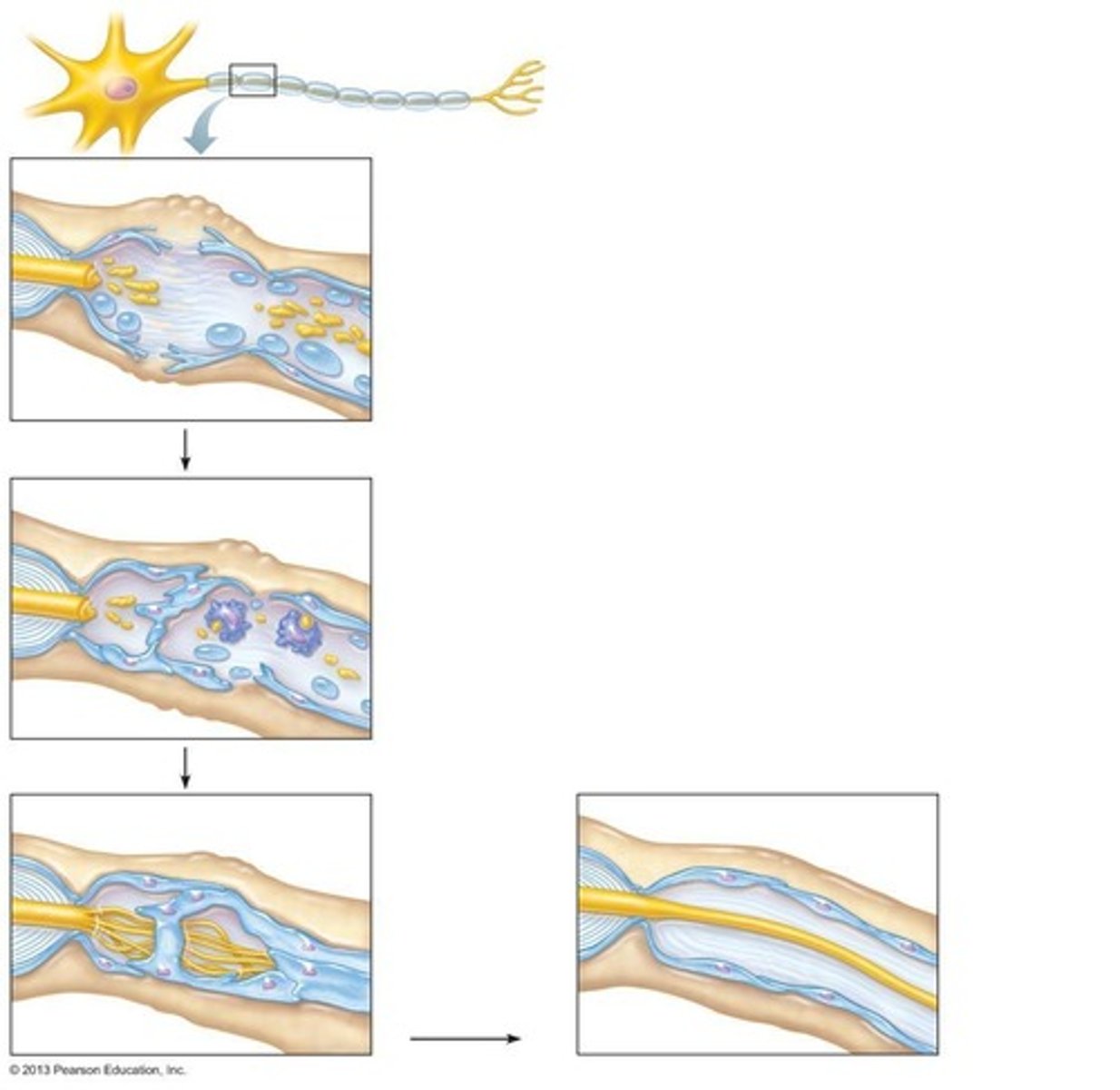 <p>Axon fragments spread distally from the injury, and macrophages clean the dead axon while the myelin sheath remains intact.</p>