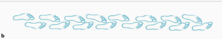 <p>Describe the walk (and etiology)</p>