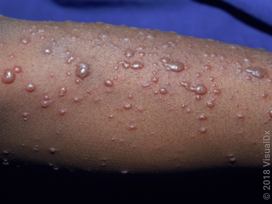 <ol><li><p>light skin: hot, painful, and red</p></li><li><p>dark skin: hot, painful skin with red hue, brown or violet</p></li></ol><p></p>