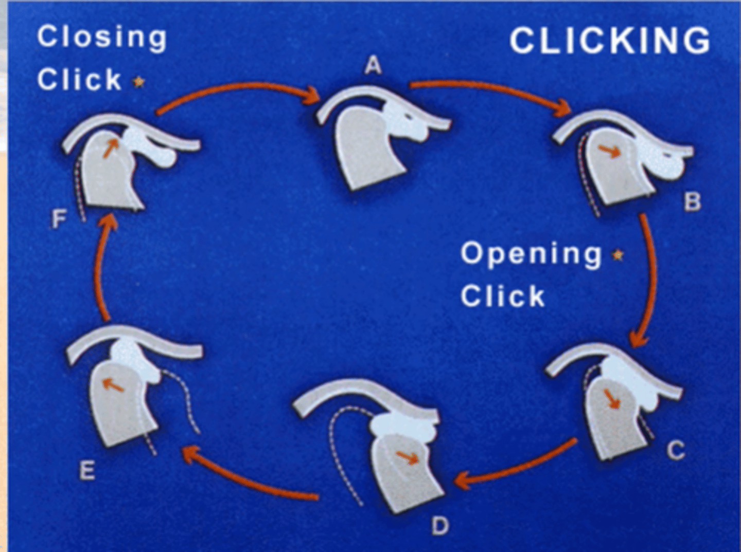 <p>(popping) disc</p><p>(typically anteriorly displaced)</p><p>NOT STUCK = moves too much </p><p>= pain and degeneration of disk. </p><p>Classic scenario:</p><p>- opening pop of the disk </p><p>and </p><p>- closing pop of the disk </p><p>as it snaps in and out of place on the condyle.</p>
