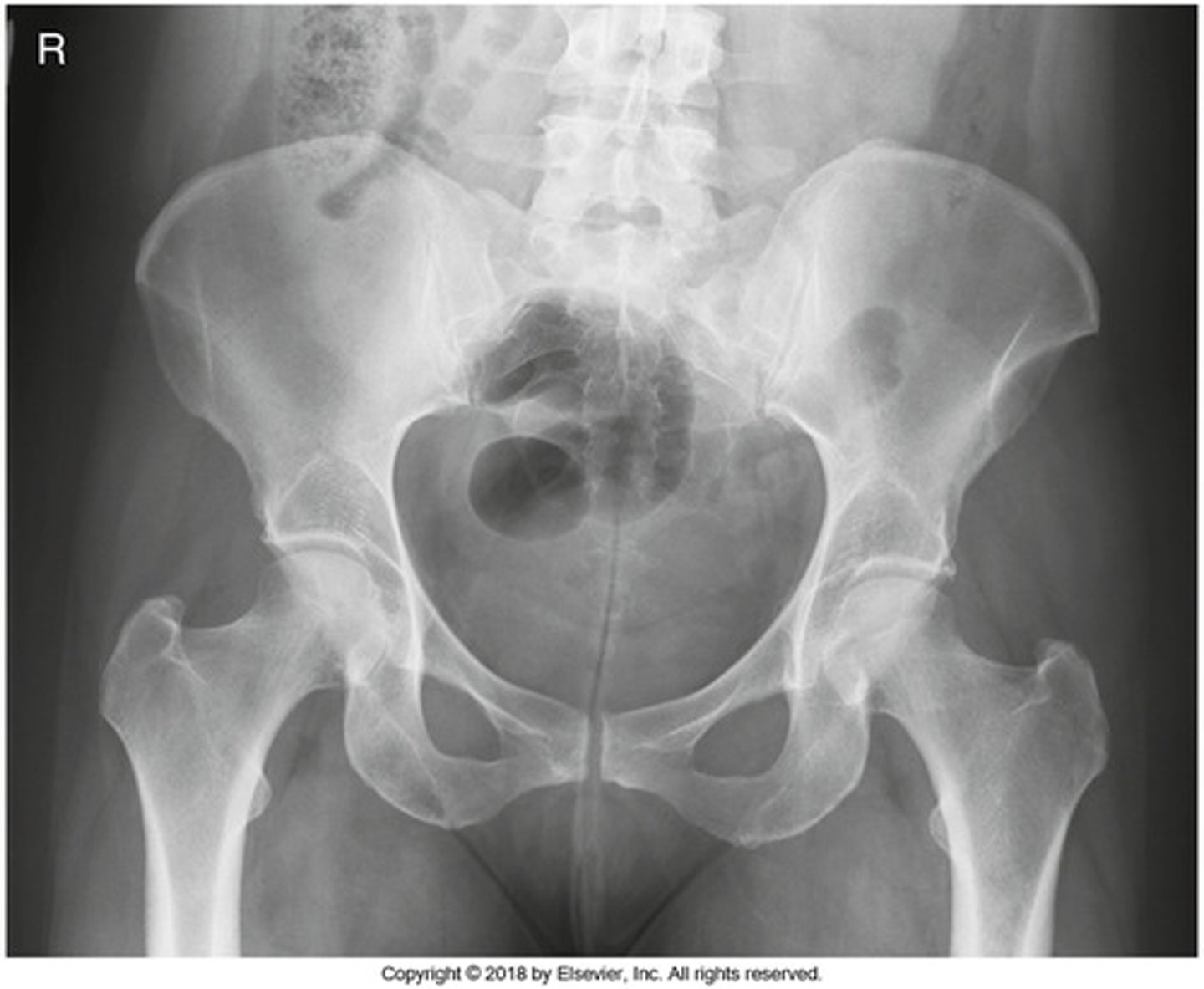 <p>Identify the projection:</p><p>AP hip</p><p>AP oblique hip</p><p>AP pelvis</p><p>Lateral hip</p>