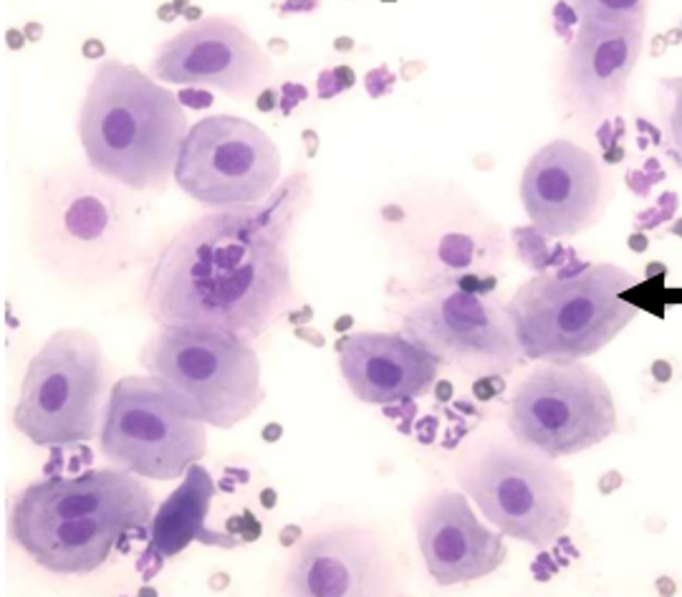 <p>predominant cell type = parabasal and small intermediate cells over 40-60%, neutrophils </p><p>RBCs, cellular debris, sperm cells vary </p>