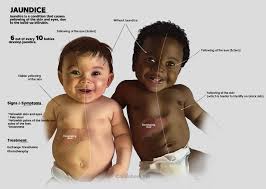 <ol><li><p>light skin: yellowish</p></li><li><p>dark skin: darker yellowish</p></li></ol><p></p>