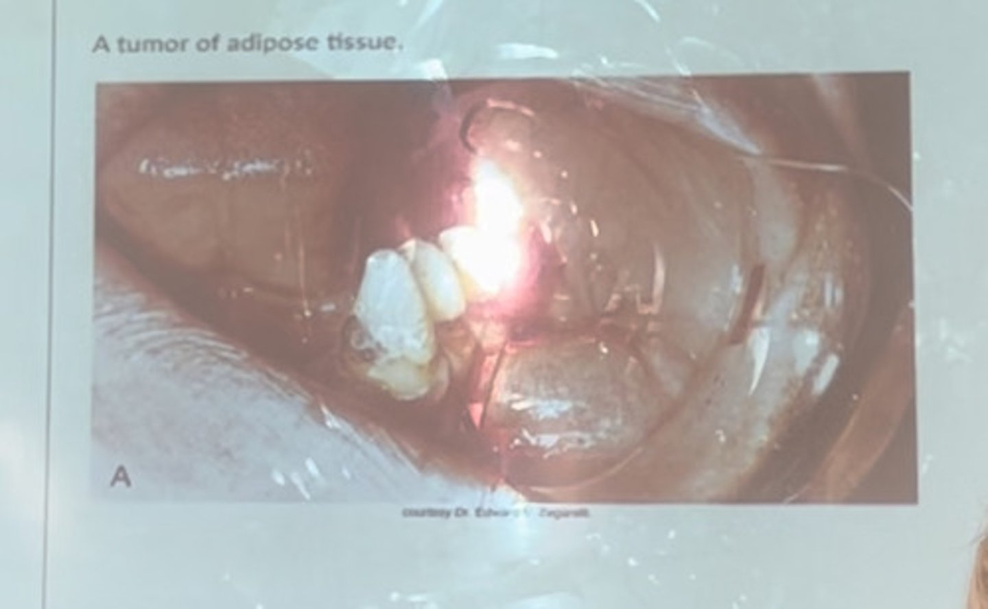 <p>A tumor of adipose tissue</p>