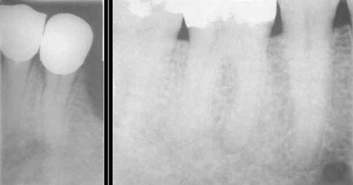 <p><span>located </span><span style="color: red;"><span>below and distal</span></span><span> to the apex of the 1st premolar</span></p><p><span>may be mistaken for a pathological lesion when it appears close to the apex of one of the premolars, which is due to the angle at which the radiograph is taken</span></p>