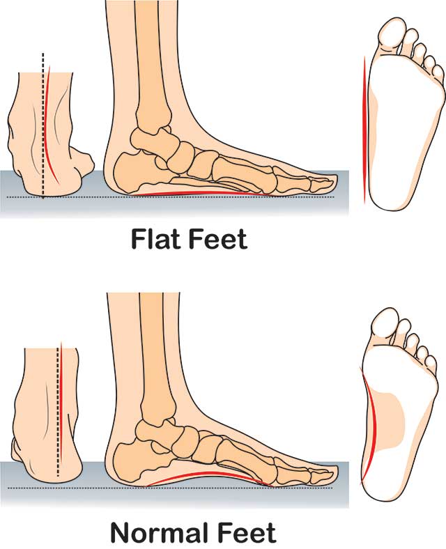 Flatfoot (born with it) no medial or longitudinal arches 