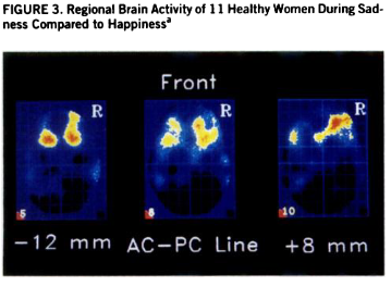 <p>Significantly more activity in right ACC, PFC, thalamus, and basal ganglia. Significantly less activity in visual cortex. </p><p>Areas with MORE activity during sadness than happiness task. </p>