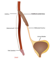 <p>what type of anomalies of urachus is this</p>