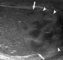<p>This scan was performed on a patient whose been feeling pain and swelling around the area. What can be assumed here?</p>