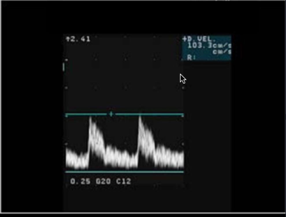 <p>What is being measured on the Doppler tracing?</p><p>a. resistive index <br>b. peak diastolic velocity <br>c. peak systolic velocity <br>d. end diastolic velocity</p>
