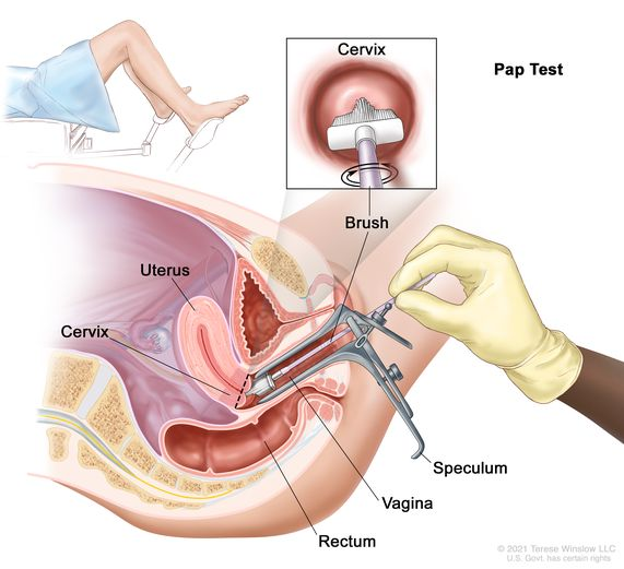 A procedure in which a small brush is used to gently remove cells from the surface of the cervix and the area around it

Used for **early detection of cervical cancer and inflammatory tissue change**