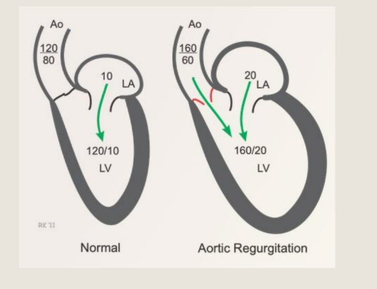<p>The left ventricle is being</p><p>filled by 2 sources...the</p><p>left atrium and the aortic</p><p>regurgitation</p>