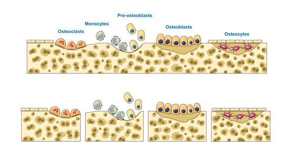 <ul><li><p>process by which osteoclasts resorb old or damaged bon at the same time as and on the same surface where osteoblasts form new bone to replace that which is resorbed</p></li><li><p>during adult life</p></li><li><p>injury, exercise, and other activities lead to remodeling</p></li></ul><p></p>