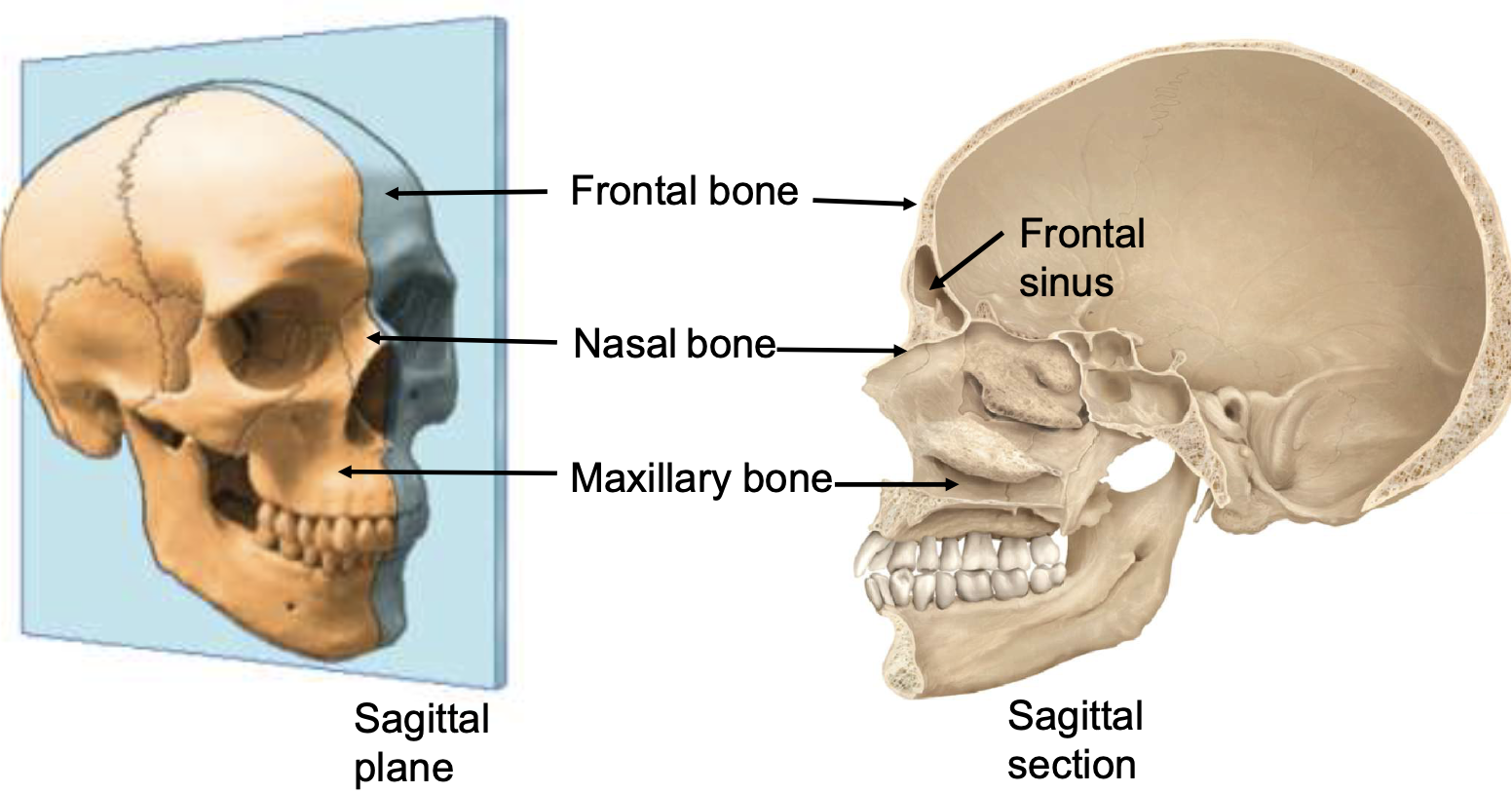 <p>frontal bone, frontal sinus, nasal bone, maxillary bone</p>
