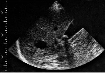 <p><span>An asymptomatic patient presents to the ultrasound department for evaluation of a solitary hepatic mass documented on a recent computed tomography (CT) examination. A nonvascular anechoic structure is identified in the area in question. Based on this clinical history and sonogram, the mass identified is most consistent with a(n):</span></p>