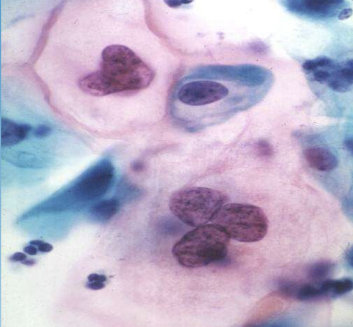 <p>Cervical Intraepithelial Neoplasia (CIN)</p>