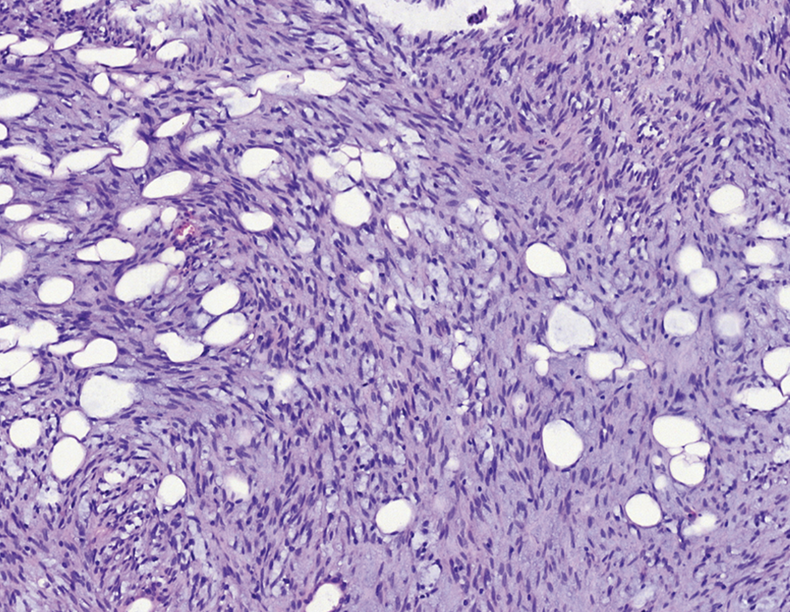 <p>Patient de 40 ans avec tumeur de la parotide</p><p>1) Diagnostic </p><p>2) Epidemiologie </p><p>3) Histologie </p><p>4) IHC</p><p>5) moléculaire </p><p>6) DD </p>
