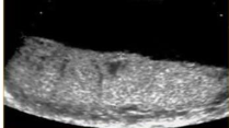 <p>Normal placenta </p>