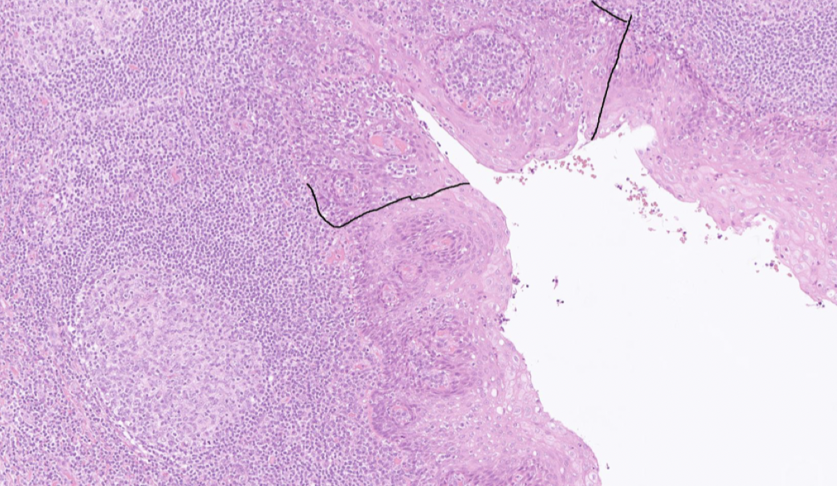 <p>I en tonsillkrypta finns <strong>retikulärt epitel</strong>. Det är mer permeabelt för lymfocyter, i epitelet finns residenta lymfocyter. </p>