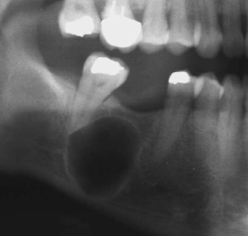 <p>describes a lesion that has a single compartment or cavity. </p>