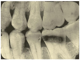 <p>What is the problem with this YELLOW-BROWN STAINS X-ray?</p>