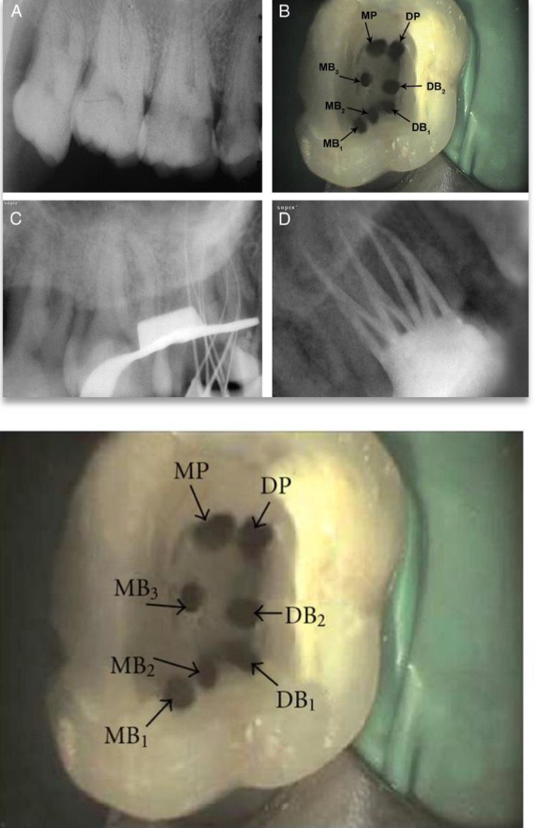 <p>Single root and canal&nbsp;</p><p>2 distal canals&nbsp;</p><p>2 palatal roots&nbsp;</p><p>Variations in anatomy&nbsp;</p><p>3 MB canals</p><p>8 canals&nbsp;</p>