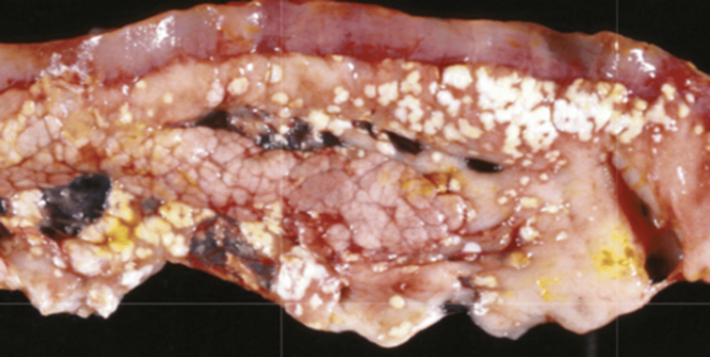 <p>What type of necrosis is being shown in this photo?</p>