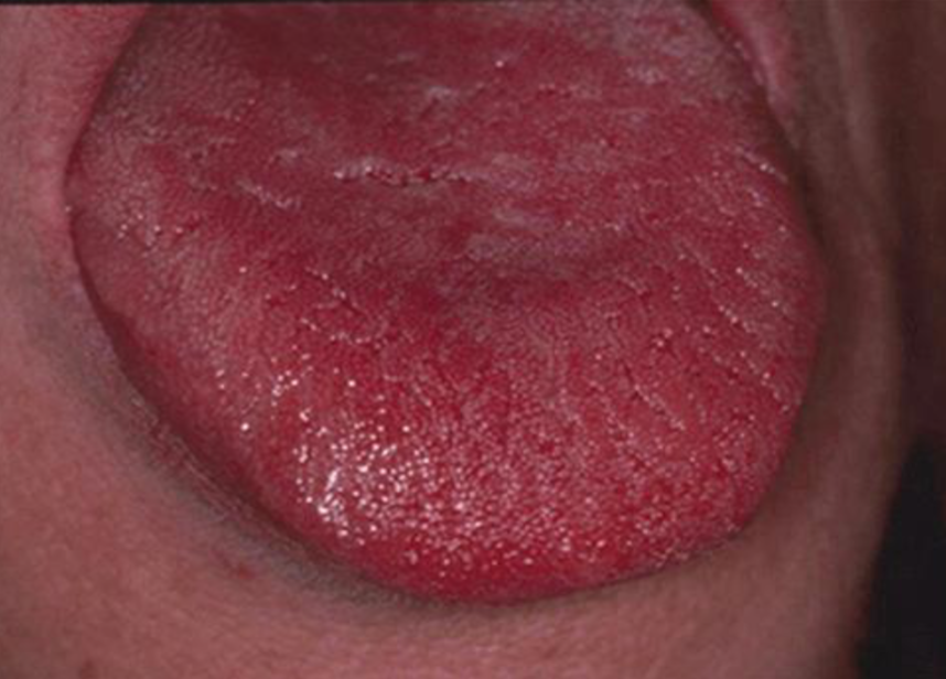 <p>CANDIDIASIS after ANTIBIOTIC therapy</p>