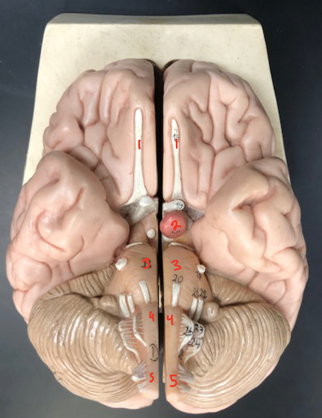 <p>Anterior to temporal lobe</p>