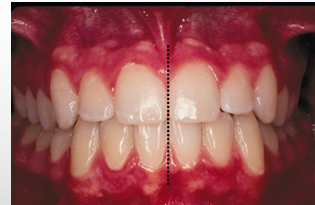 <p>-maxillary dental midline: a line drawn perpendicular to the maxillary occlusal plane through the proximal contacts of the central incisors</p><p>-mandibular dental midline: a line drawn perpendicular to the mandibular occlusal plane through the proximal contacts of the central incisors</p><p>-if deviation- must say what direction and by how much</p>