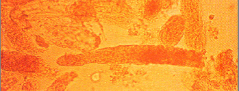 <p>Identify the urine sediment elements present in this illustration:</p><p>WBC casts</p><p>Hyaline casts</p><p>Waxy casts</p><p>Fine granular casts</p>
