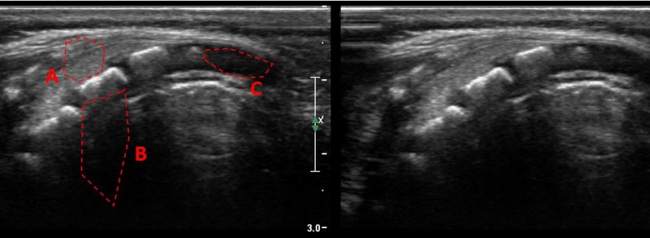 <p>State the ultrasound phenomena in the indicated area (specular reflection, transmission, scattering, enhancement, shadowing)</p>