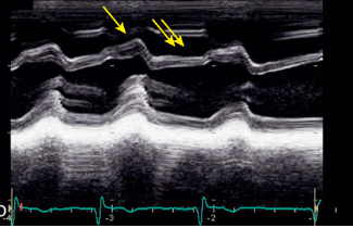 <p>What is the arrow pointing to?</p><p>What condition is this finding demonstrated in?</p>