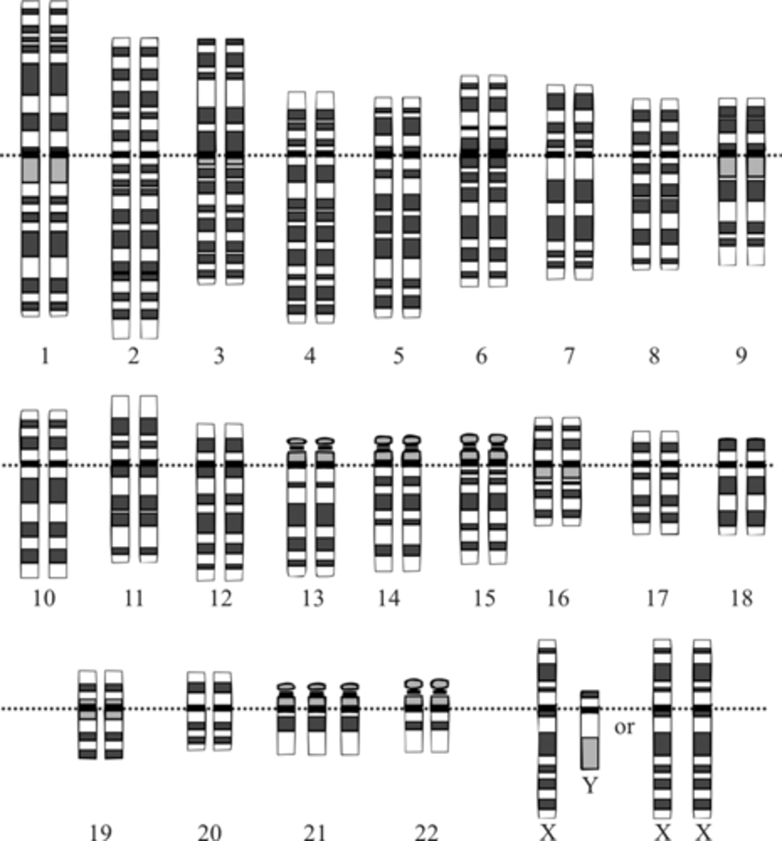 <p>Down syndrome (or trisomy 21); karyotyping</p>